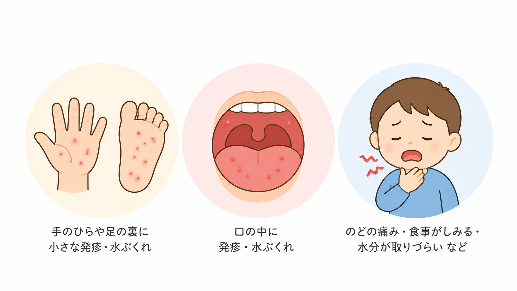 手足口病の主な症状